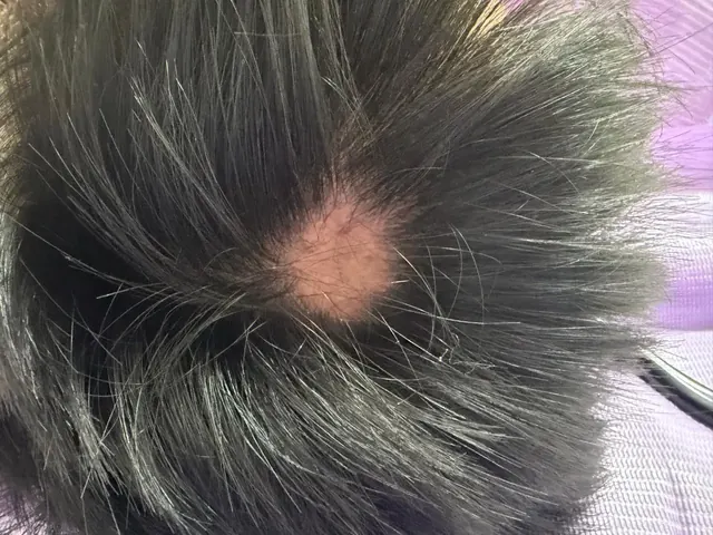 Caso de alopecia tratado con plasma rico en plaquetas y ozonoterapia