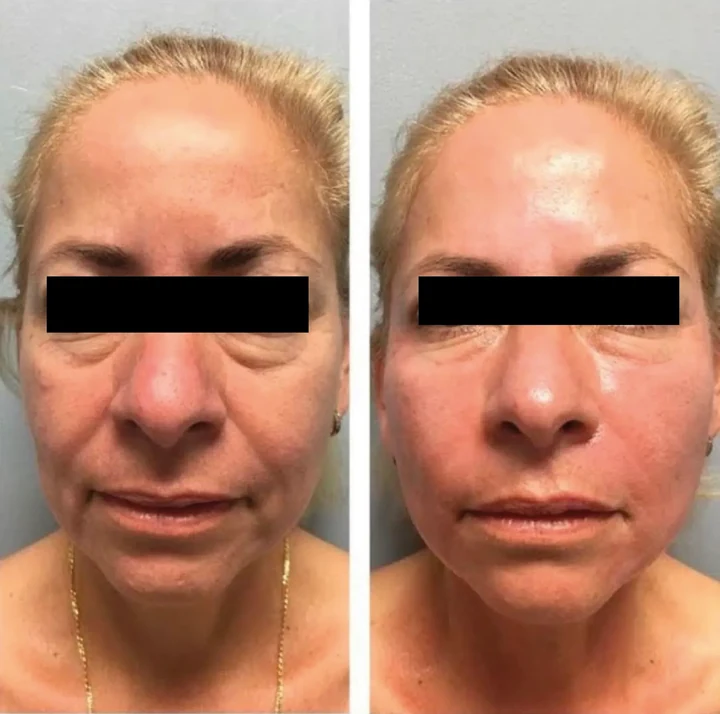 Antes y después de rejuvenecimiento facial en Bella Aura Quito