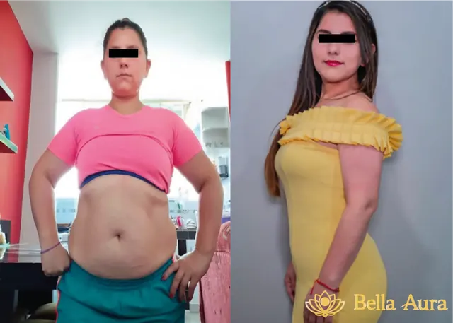 Antes y después de reducción de medidas con mini lipo en Bella Aura Quito