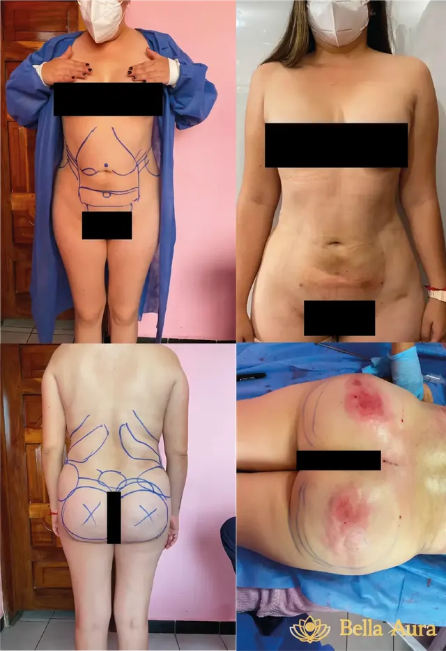 Proceso de mini lipo con transferencia de grasa