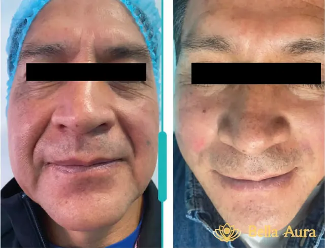 Antes y después de rejuvenecimiento facial con hilos tensores