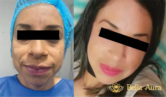 Antes y después de rejuvenecimiento facial