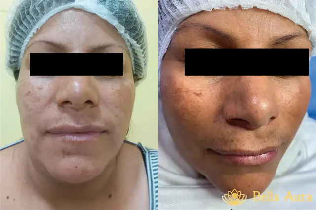 Caso adicional de lipopapada