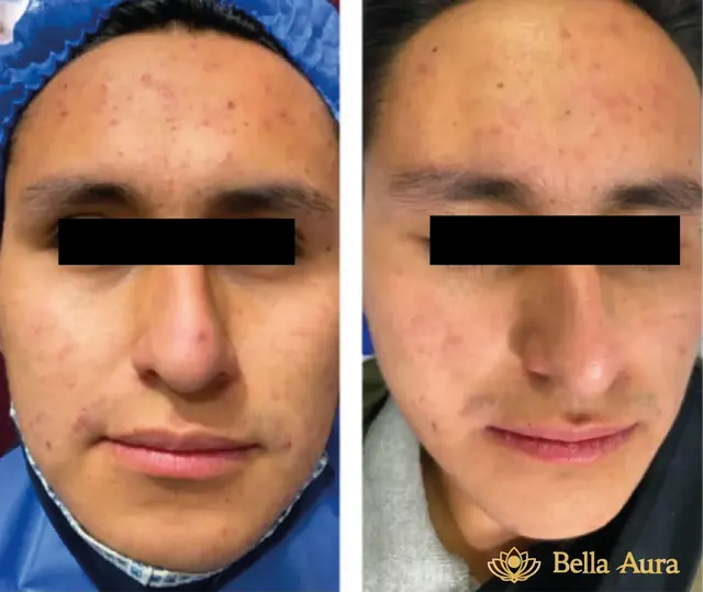 Antes y después de tratamiento para acné en Bella Aura Quito