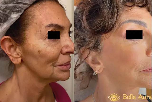 Antes y después de tratamiento de manchas en Bella Aura Quito